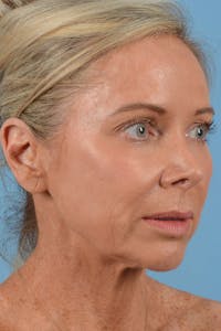 Eyelid Lift Before & After Gallery - Patient 20906540 - Image 1