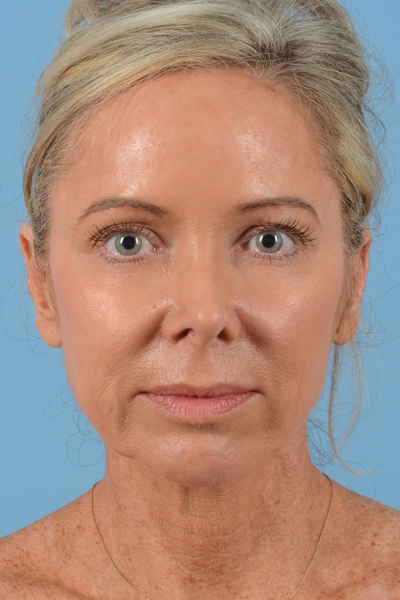 Eyelid Lift Before & After Gallery - Patient 20906540 - Image 3