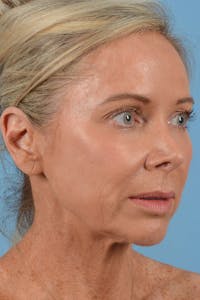 Facelift Before & After Gallery - Patient 20906556 - Image 1