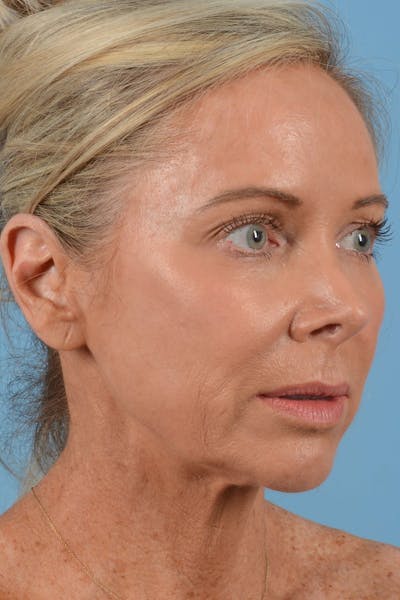 Facelift Before & After Gallery - Patient 20906556 - Image 1