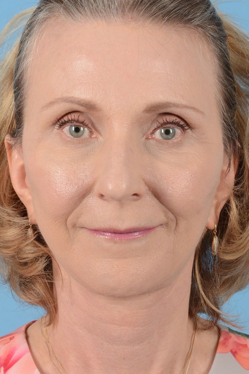 Facelift Before & After Gallery - Patient 20906578 - Image 4