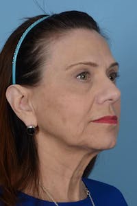Facelift Before & After Gallery - Patient 20906586 - Image 1