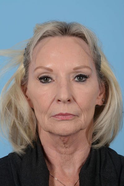 Facelift Before & After Gallery - Patient 20906588 - Image 1