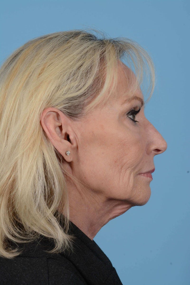 Facelift Before & After Gallery - Patient 20906588 - Image 5
