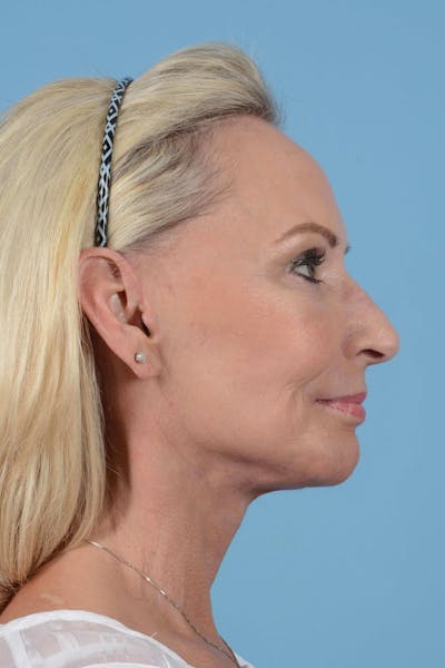 Facelift Before & After Gallery - Patient 20906588 - Image 6