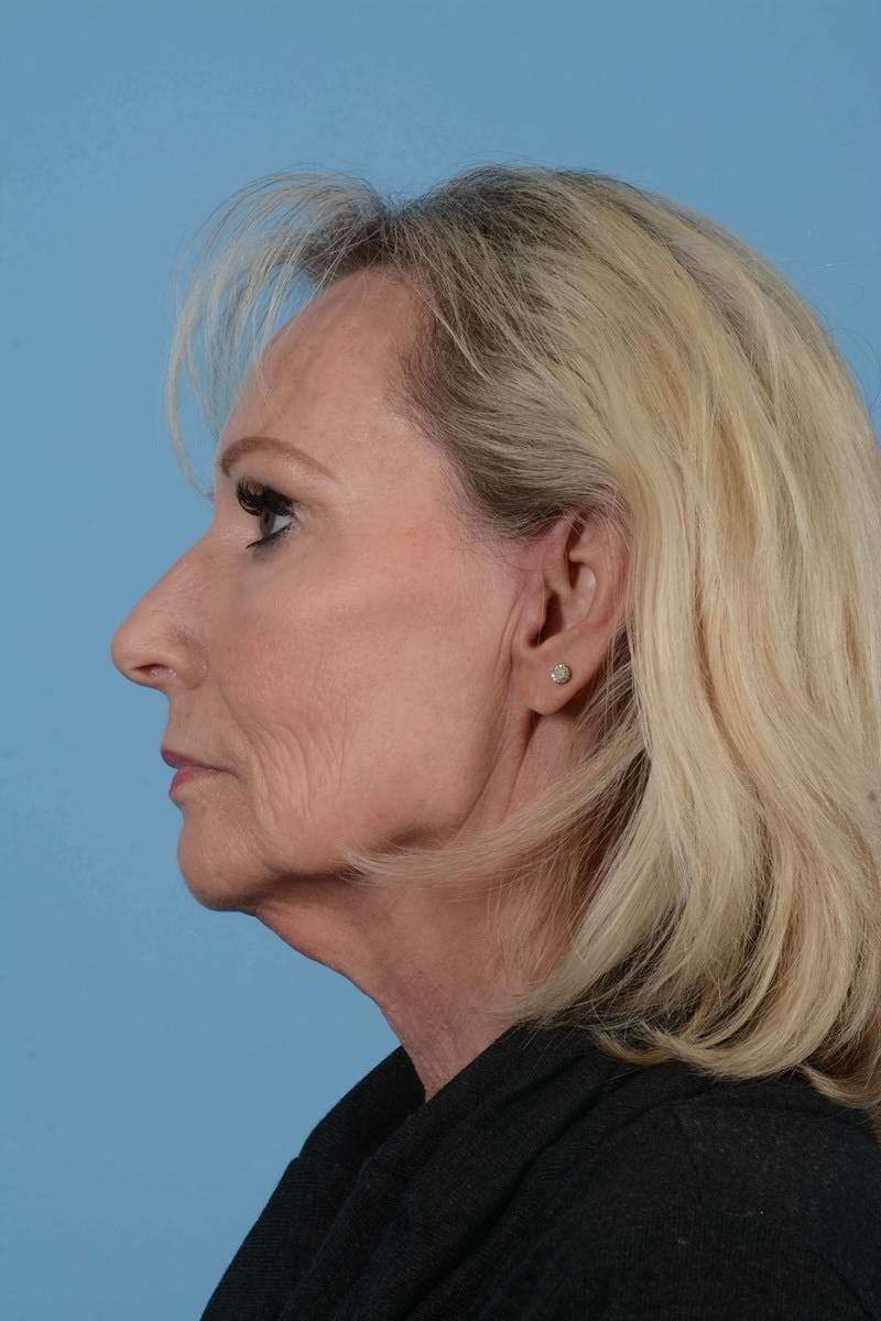Facelift Before & After Gallery - Patient 20906588 - Image 9