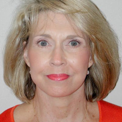 Facelift Before & After Gallery - Patient 20906606 - Image 2