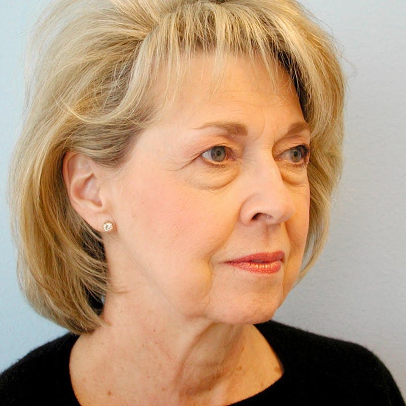 Facelift Before & After Gallery - Patient 20906606 - Image 3