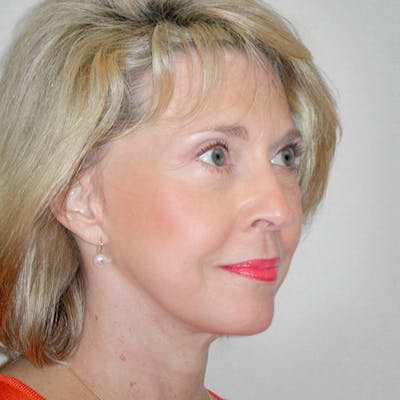 Facelift Before & After Gallery - Patient 20906606 - Image 4