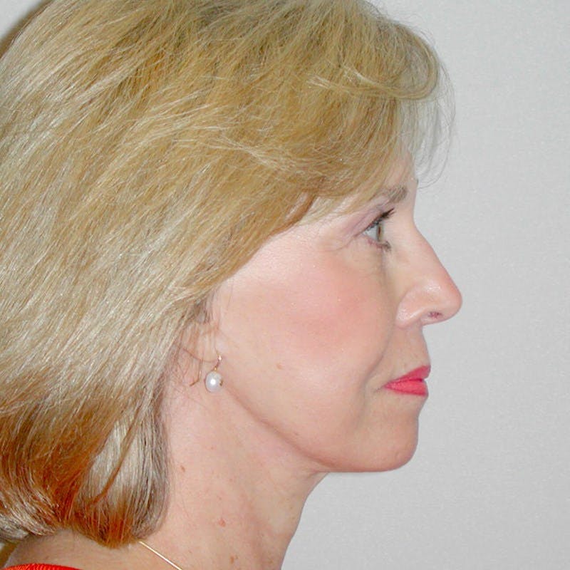 Facelift Before & After Gallery - Patient 20906606 - Image 6