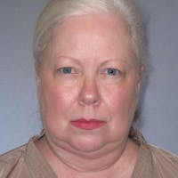 Facelift Before & After Gallery - Patient 20906607 - Image 1