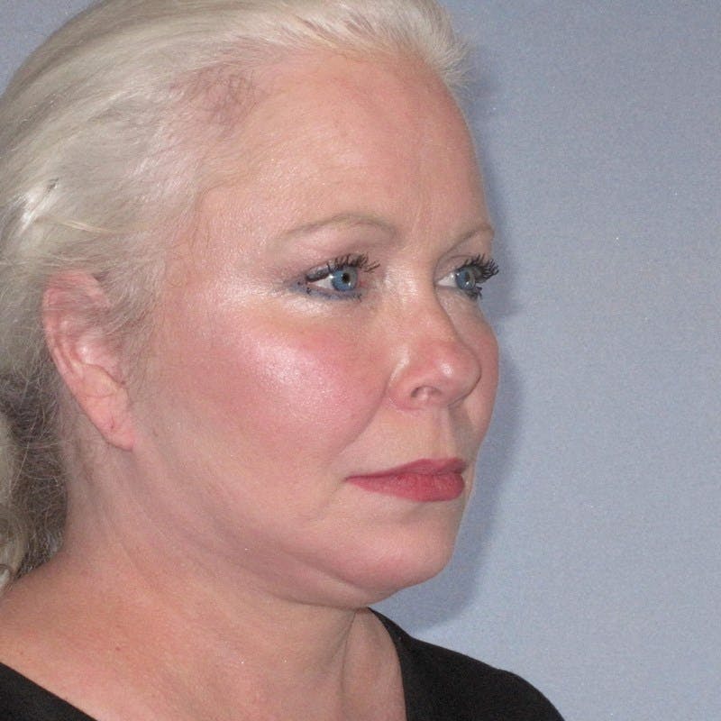 Facelift Before & After Gallery - Patient 20906607 - Image 6