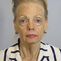 Facelift Before & After Gallery - Patient 20906608 - Image 1