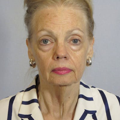 Facelift Before & After Gallery - Patient 20906608 - Image 1
