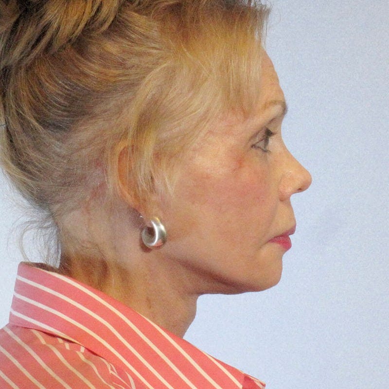 Facelift Before & After Gallery - Patient 20906608 - Image 6