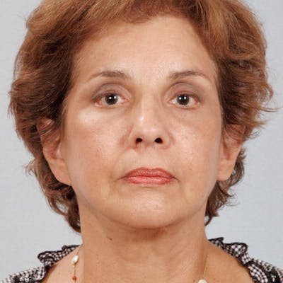 Facelift Before & After Gallery - Patient 20906624 - Image 2