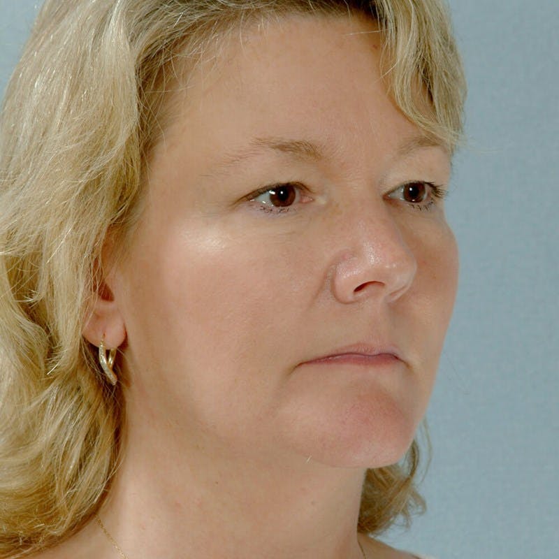 Facelift Before & After Gallery - Patient 20906631 - Image 3