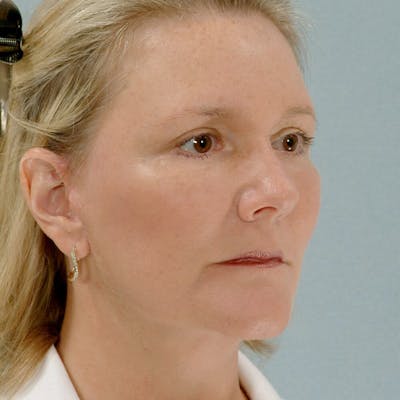 Facelift Before & After Gallery - Patient 20906631 - Image 4