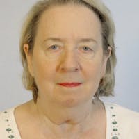 Facelift Before & After Gallery - Patient 20906645 - Image 1