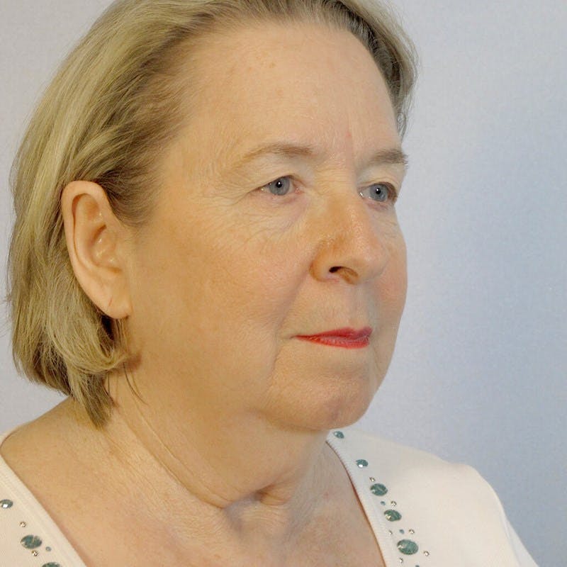 Facelift Before & After Gallery - Patient 20906645 - Image 3