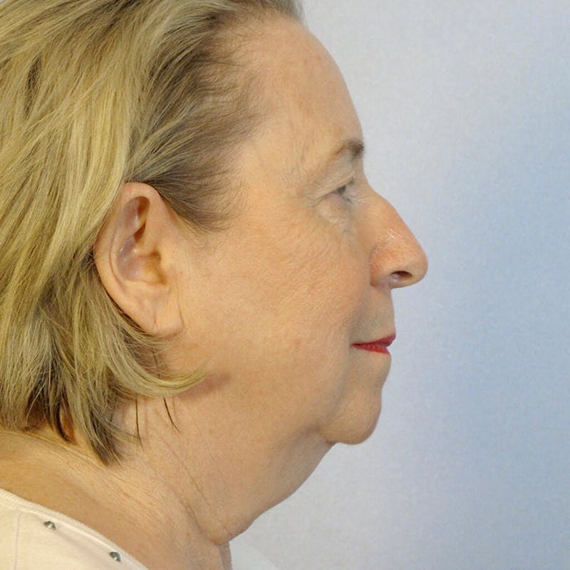 Facelift Before & After Gallery - Patient 20906645 - Image 5