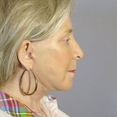 Facelift Before & After Gallery - Patient 20906645 - Image 6
