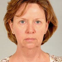 Facelift Before & After Gallery - Patient 20906646 - Image 1