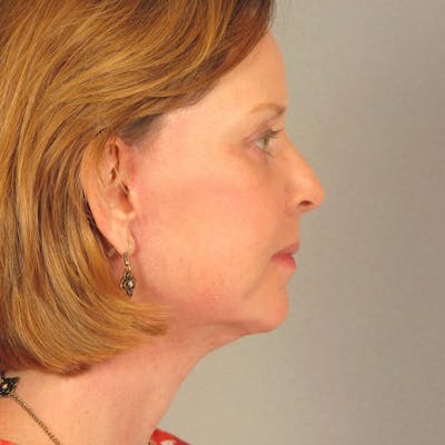 Facelift Before & After Gallery - Patient 20906646 - Image 6
