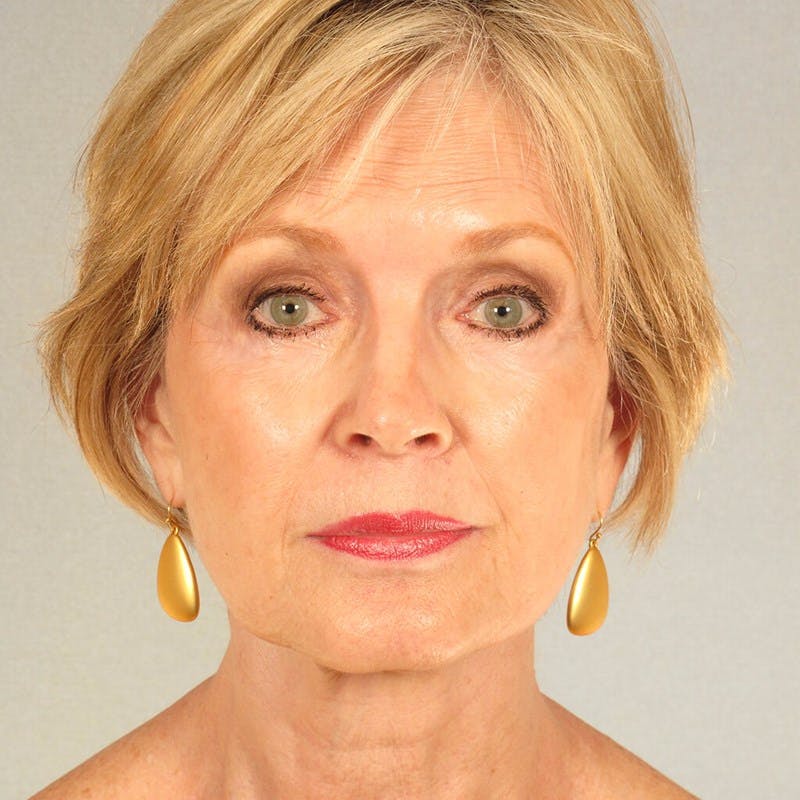 Facelift Before & After Gallery - Patient 20906647 - Image 2