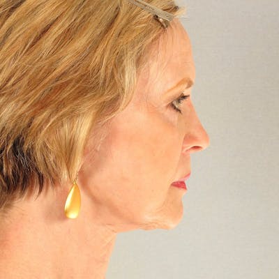 Facelift Before & After Gallery - Patient 20906647 - Image 6