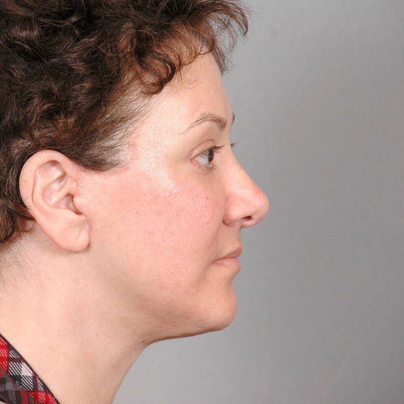 Facelift Before & After Gallery - Patient 20906654 - Image 6