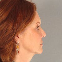 Neck Lift Before & After Gallery - Patient 20906663 - Image 1