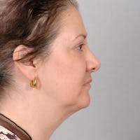 Neck Lift Before & After Gallery - Patient 20906664 - Image 1