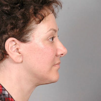 Neck Lift Before & After Gallery - Patient 20906664 - Image 2