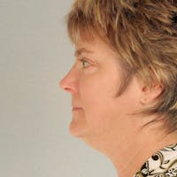 Neck Lift Before & After Gallery - Patient 20906673 - Image 1