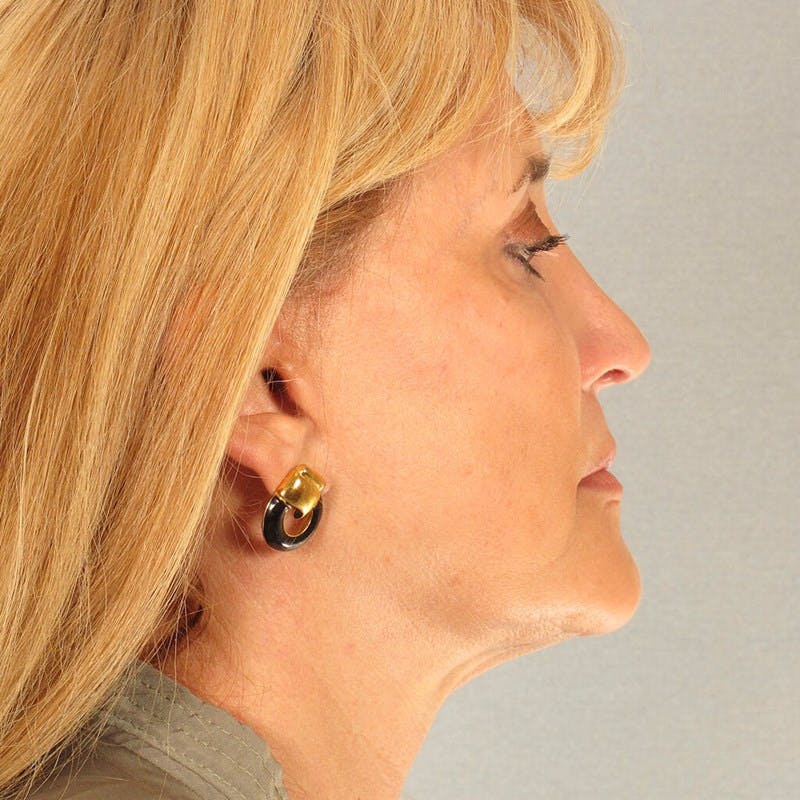Neck Lift Before & After Gallery - Patient 20906686 - Image 2