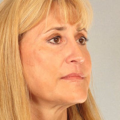 Neck Lift Before & After Gallery - Patient 20906686 - Image 4