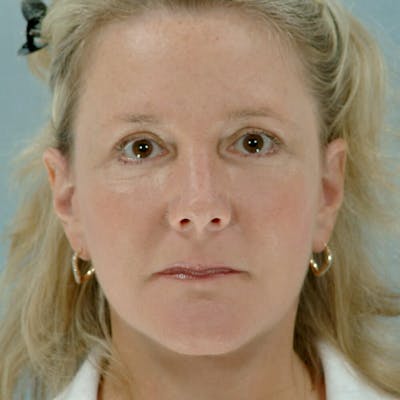 Neck Lift Before & After Gallery - Patient 20906692 - Image 2