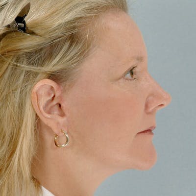 Neck Lift Before & After Gallery - Patient 20906692 - Image 6
