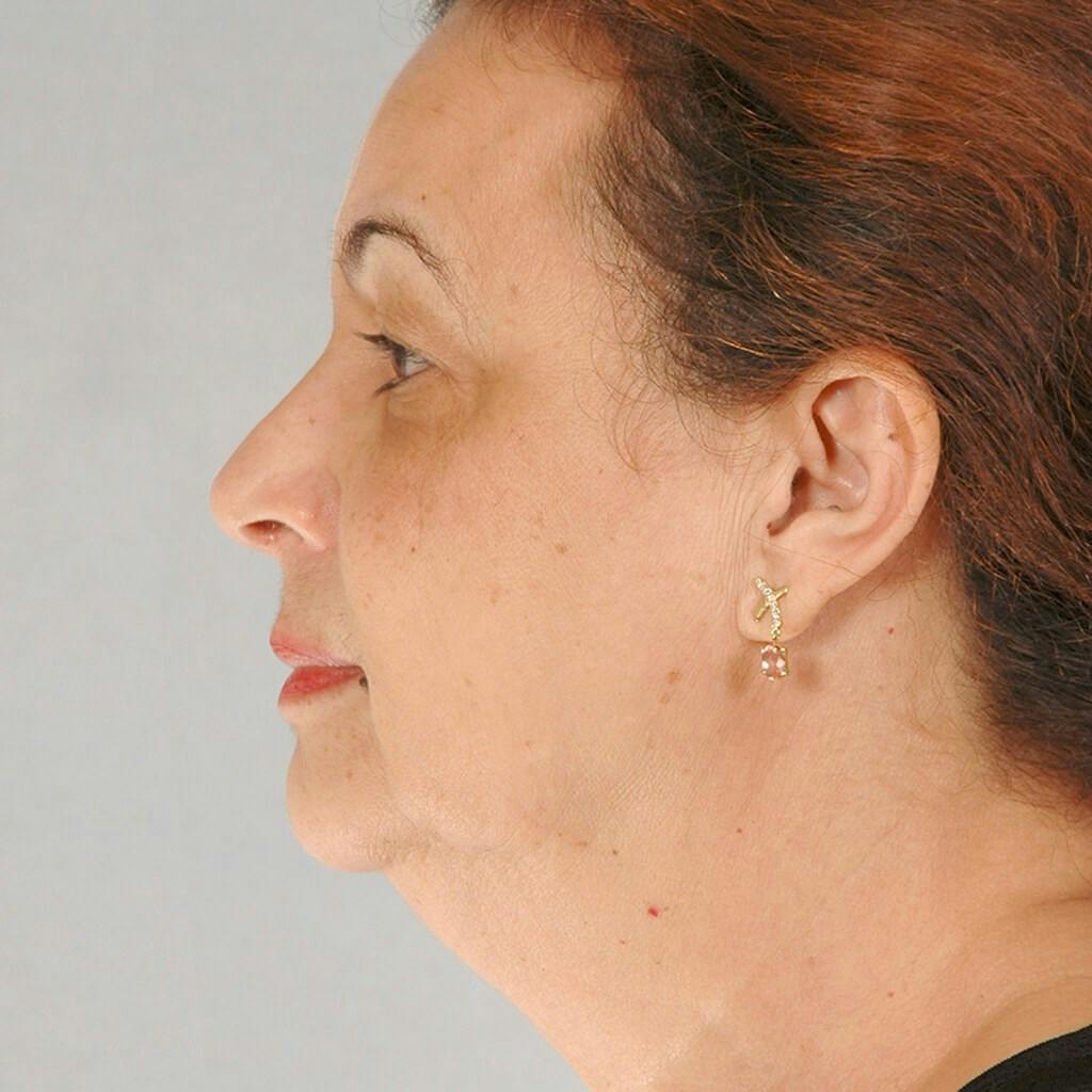 Neck Lift Before & After Gallery - Patient 20906695 - Image 5
