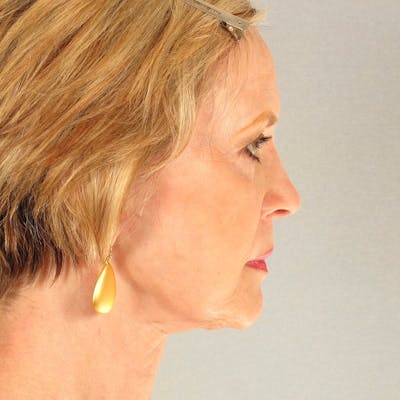 Neck Lift Before & After Gallery - Patient 20906697 - Image 6