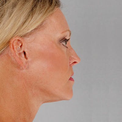 Neck Lift Before & After Gallery - Patient 20906717 - Image 6