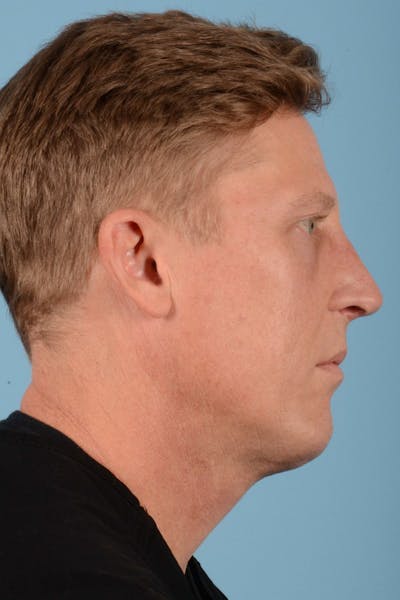 Rhinoplasty Before & After Gallery - Patient 20909777 - Image 2