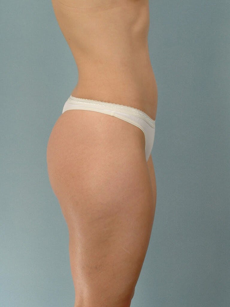 Liposuction Before & After Gallery - Patient 20909774 - Image 5