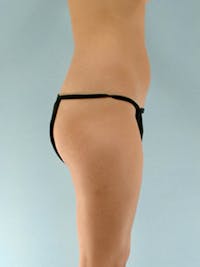 Brazilian Butt Lift Before & After Gallery - Patient 20909776 - Image 1