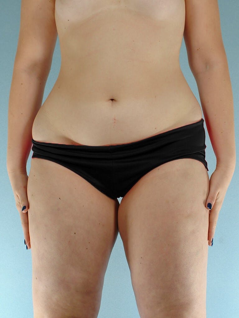 Liposuction Before & After Gallery - Patient 20909778 - Image 1