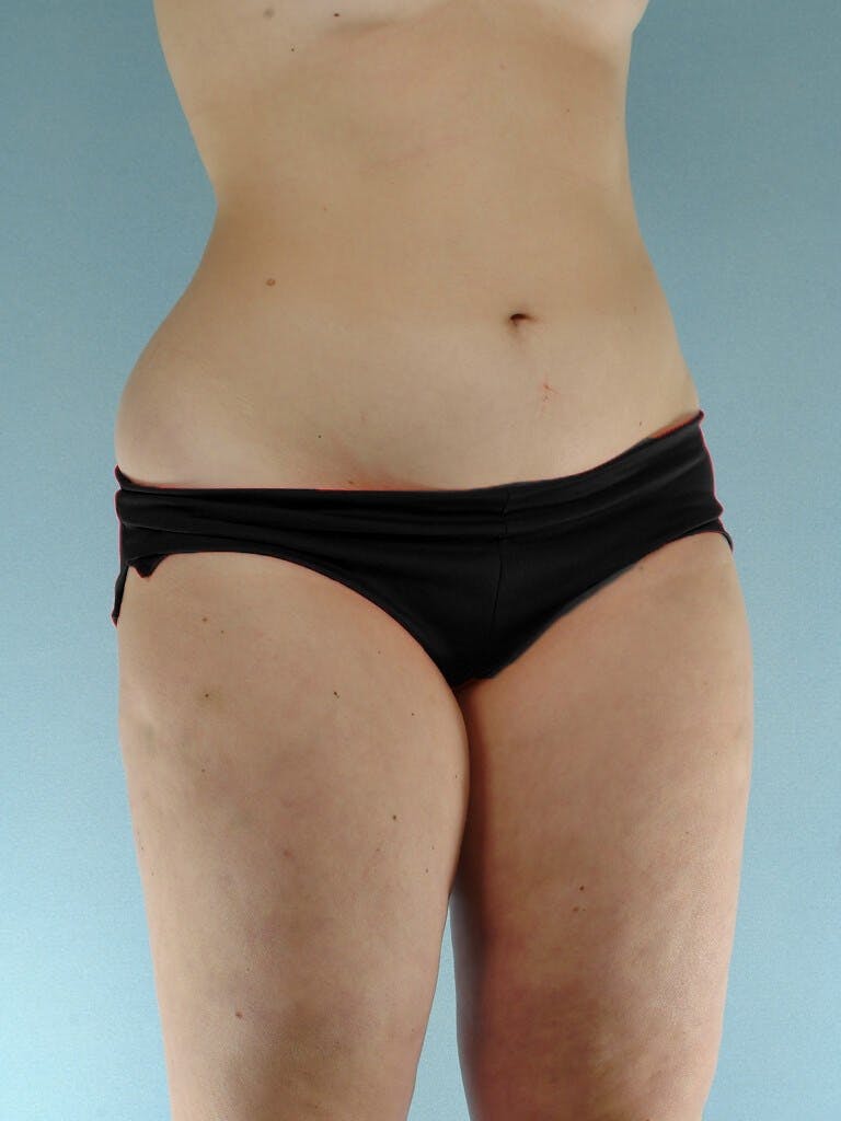 Liposuction Before & After Gallery - Patient 20909778 - Image 3