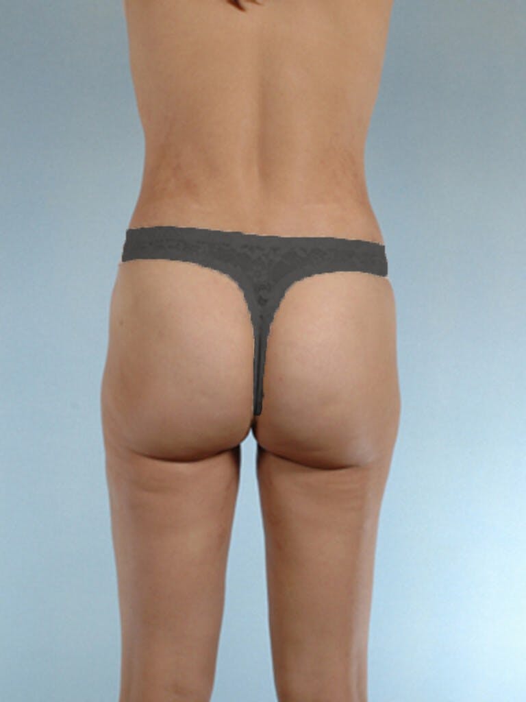 Brazilian Butt Lift Before & After Gallery - Patient 20909776 - Image 8