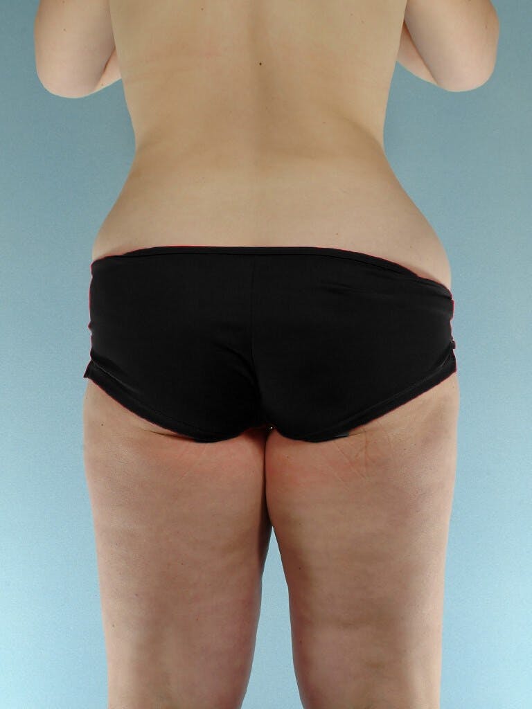 Liposuction Before & After Gallery - Patient 20909778 - Image 5