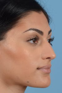 Rhinoplasty Before & After Gallery - Patient 20909783 - Image 1